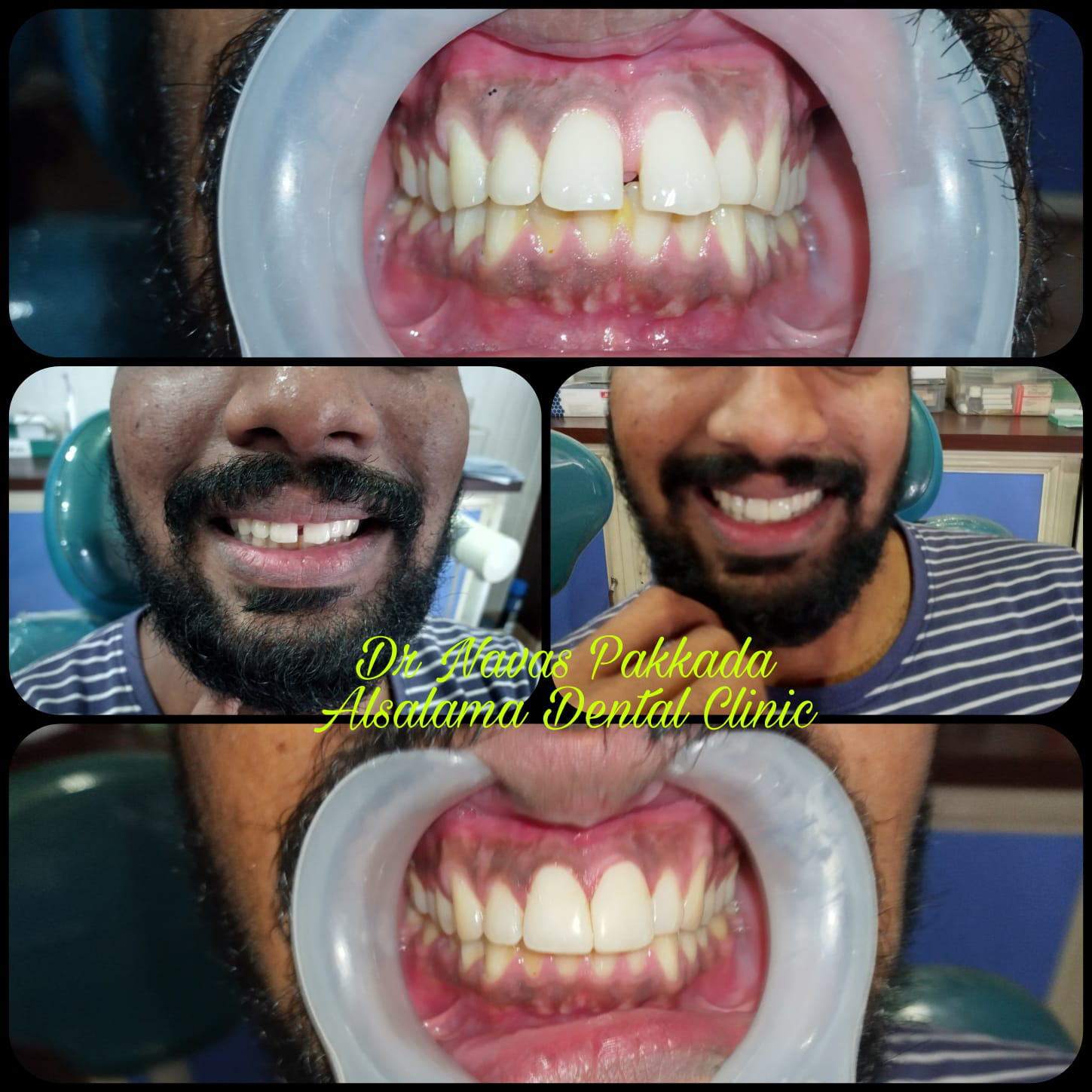 Midline diastema closure